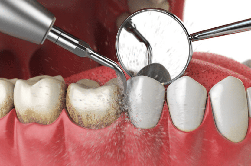 4 Steps Involved In Periodontitis Therapy