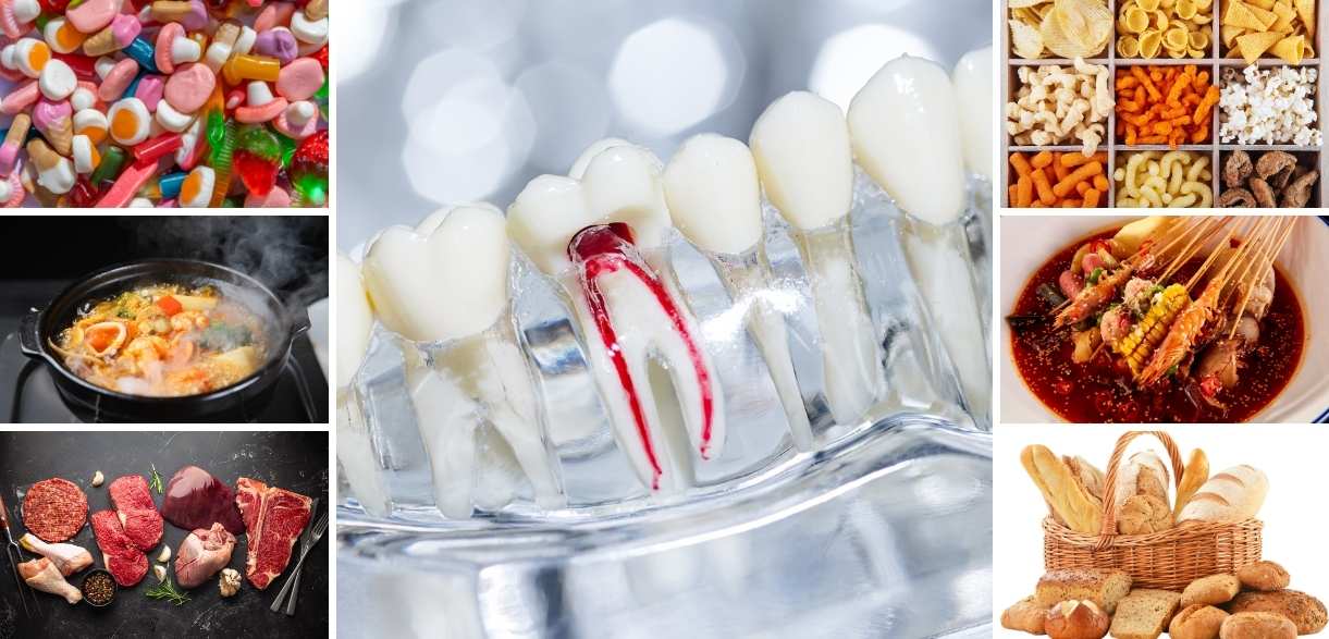 Featured image for “Foods to Avoid After a Root Canal to Protect Your Tooth”